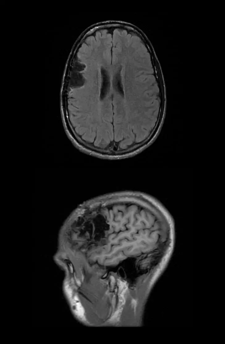 A pair of MRI images of a human head showing a traumatic brain injury.