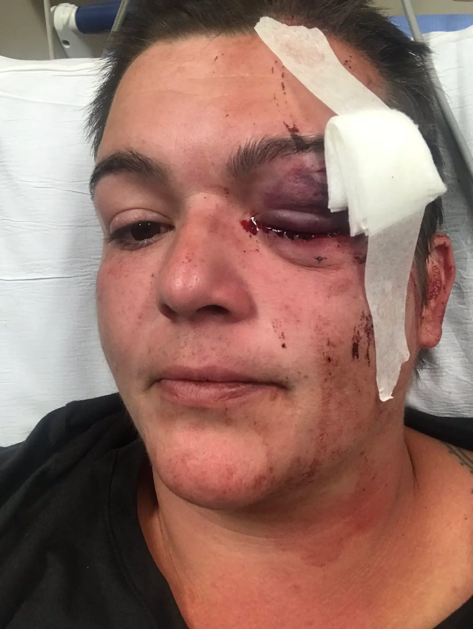 A selfie tweeted by Linda Tirado May 29, 2020. Alongside the image, she tweeted, "Hey folks, took a tracer found to the face (I think, given my backpack) and am headed into surgery to see if we can save my left eye."
