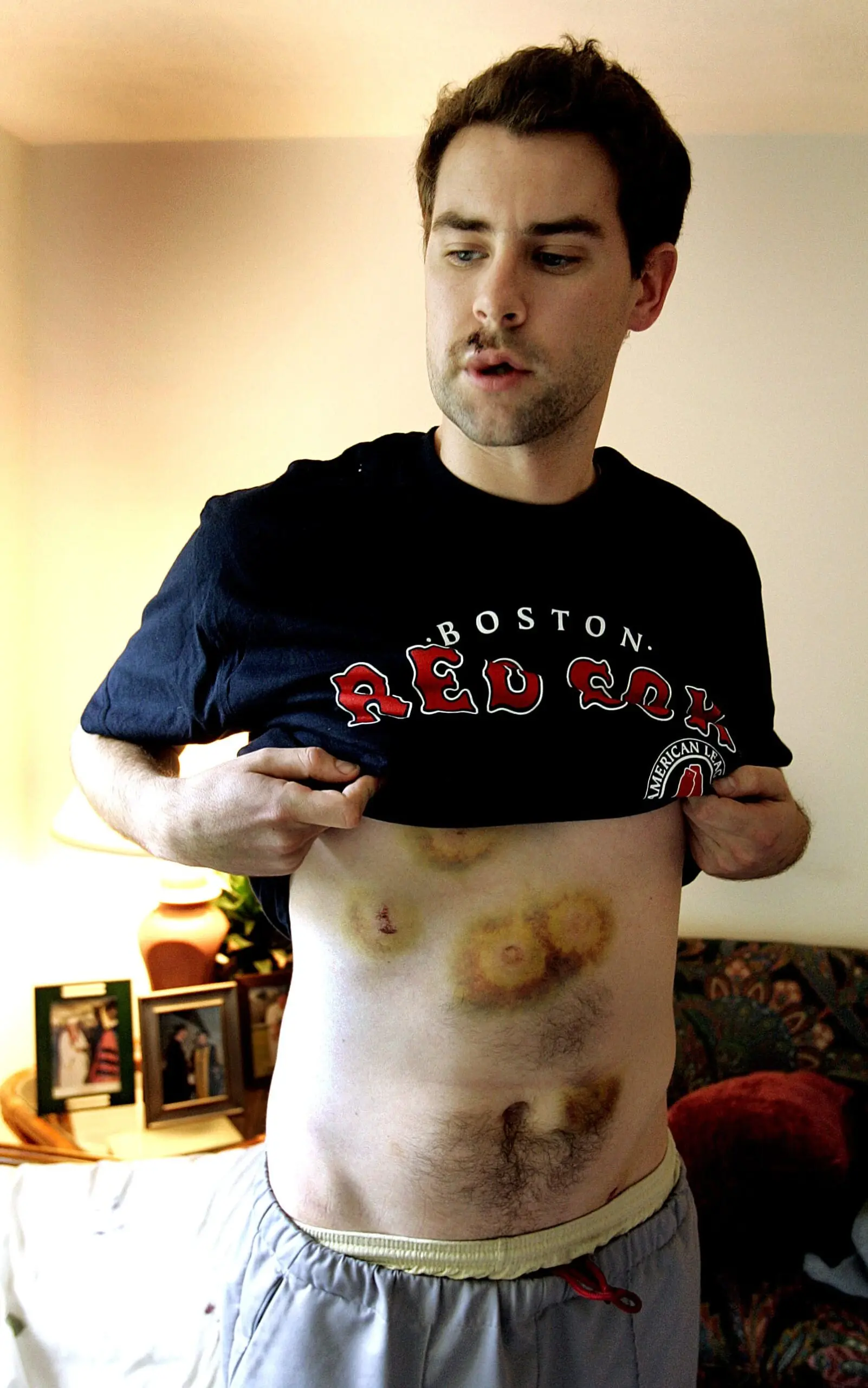 Paul Gately displays some of the wounds he sustained from Boston police firing pepper balls.