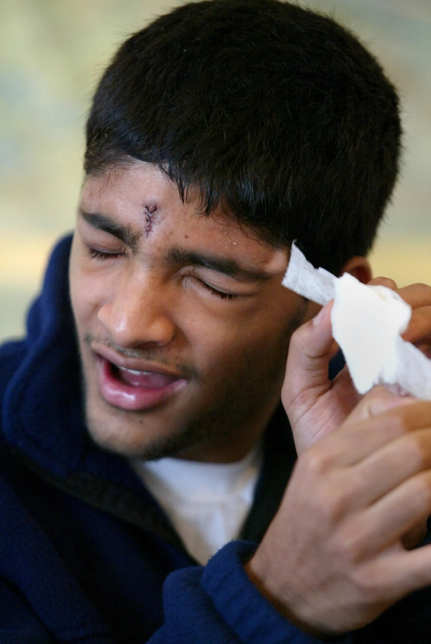 Kapila Bhamidipati removes a bandage to show the pepper ball wound he suffered outside of Fenway Park.